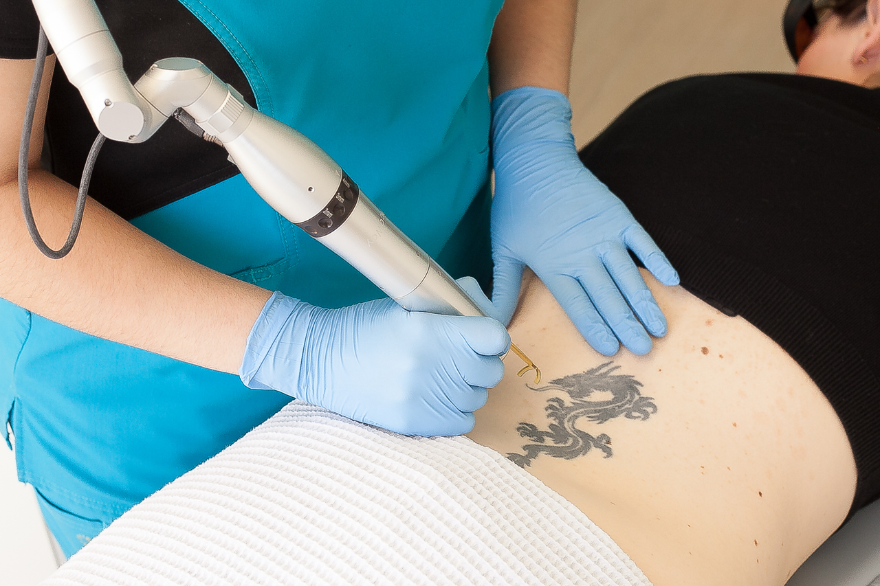 Oregon Tattoo Removal Clinic - One of the most frequently asked questions!  Patients often compare the procedure to a rubber band being snapped on  their skin - but topical anesthetic and ice